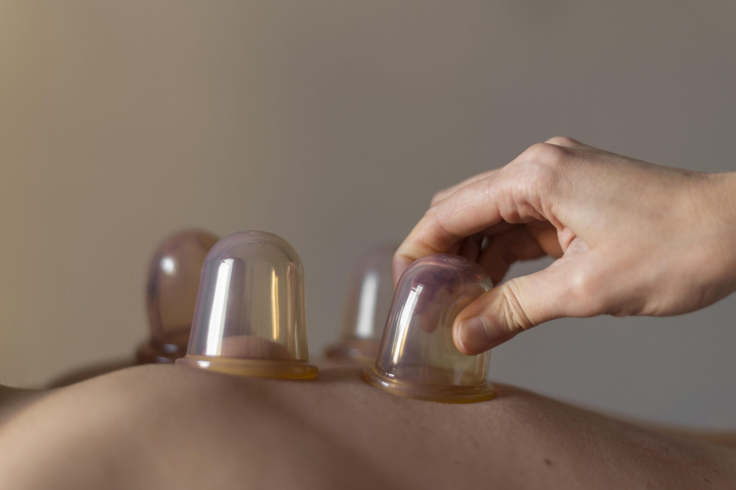 TCM Cupping Singapore, TCM Cupping In Singapore, TCM Cupping Therapy